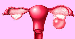 Woman With Complex Ovarian Endometrioma Gets New Lease Of Life