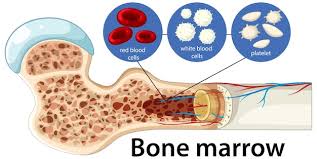Bone Marrow Transplant Is Often The Best Treatment Available