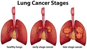 Non-Smoking Lung Cancer Cases Are Now On The Rise