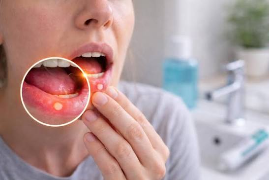 Mouth Ulcer Or Something More Serious? Know The Important Details
